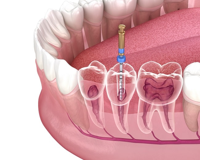 Hal-Hal yang Perlu Happy People Ketahui tentang Endodonti