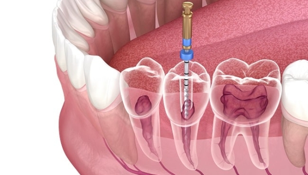 Hal-Hal yang Perlu Happy People Ketahui tentang Endodonti